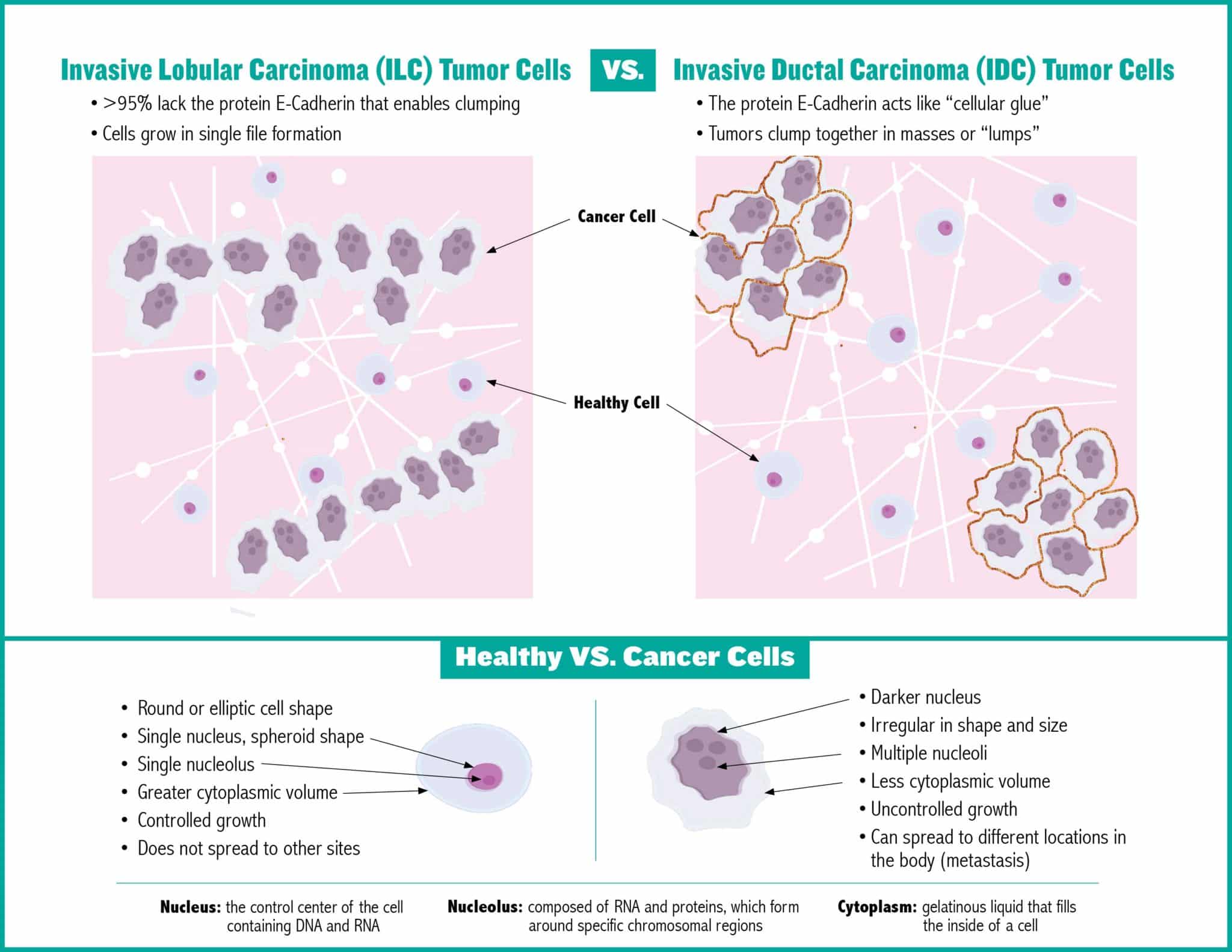 ILC Vs IDC Tumor Cells Infographic 10 21 The Lobular Breast Cancer