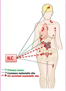 Image courtesy of the Oesterrich Lab, U Pittsburgh Illustration of a womans body with indicator arrows point to locations ILC can spread