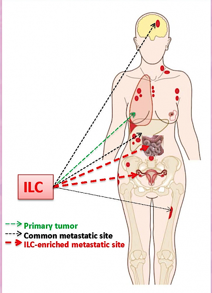 Screen Shot 2017-10-21 at 4.58.24 PM - The Lobular Breast ...