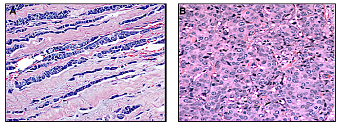 factsheet-ilc-a-unique-subtype-of-breast-cancer-the-lobular-breast