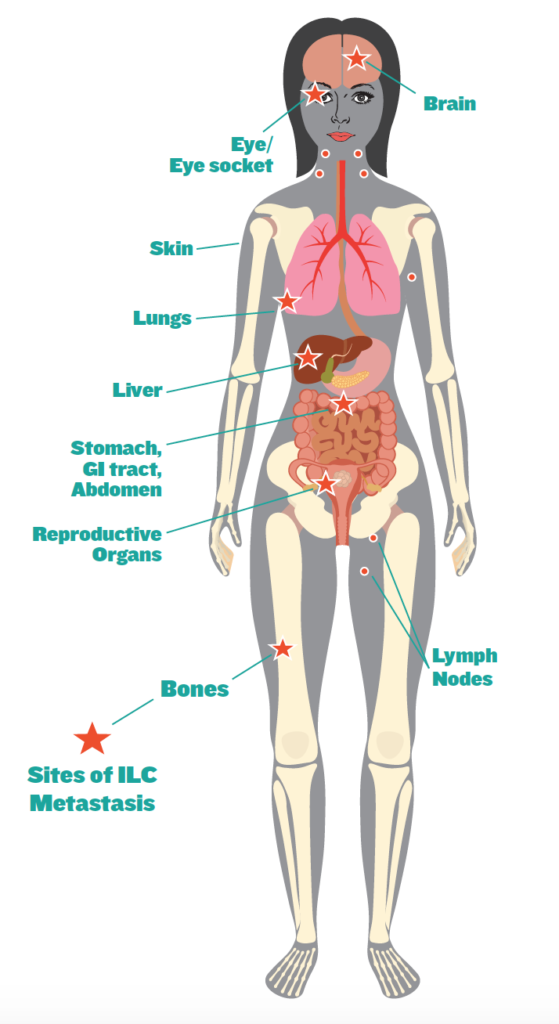 Factsheet ILC A Unique Subtype Of Breast Cancer The Lobular Breast 