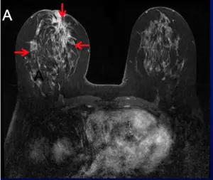 image from an MRI showing lobular breast cancer in the right breast
