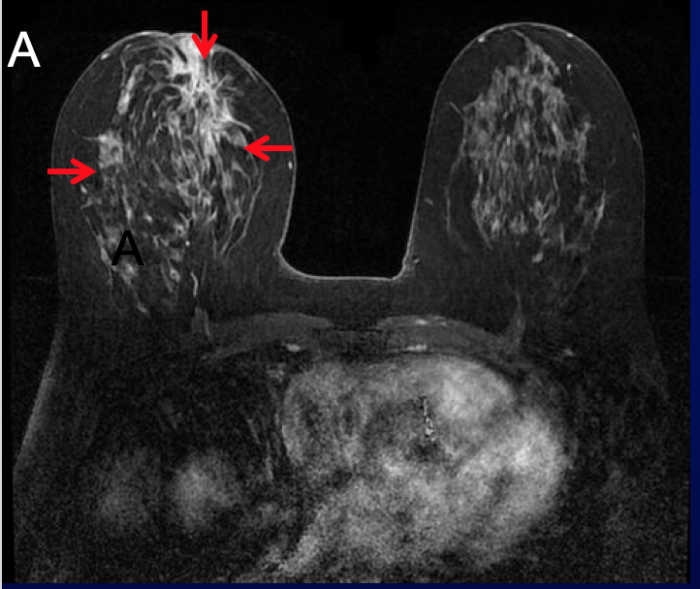 expert-opinion-imaging-and-lobular-breast-cancer-the-lobular-breast