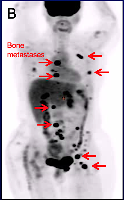 image from a FDG Pet Scan with red arrows pointing out bone metastasis in an ILC patient