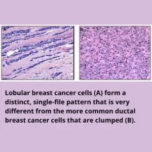 Invasive lobular carcinoma cell vs. invasive ductal carcinoma cell