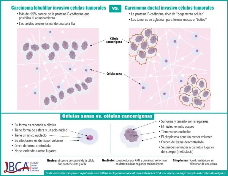 Invasive lobular carcinoma tumor cell vs. invasive ductal carcinoma tumor cell infographic