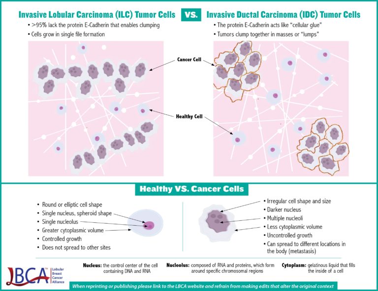 Infographic of Invasive lobular carcinoma tumor cell vs. IDC cell