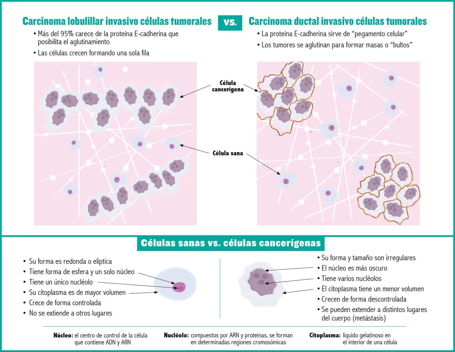 ILCvsIDCinfographicEspanol1121 The Lobular Breast Cancer Alliance