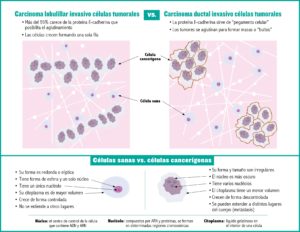 Infographic of Invasive lobular carcinoma tumor cell vs. invasive ductal carcinoma