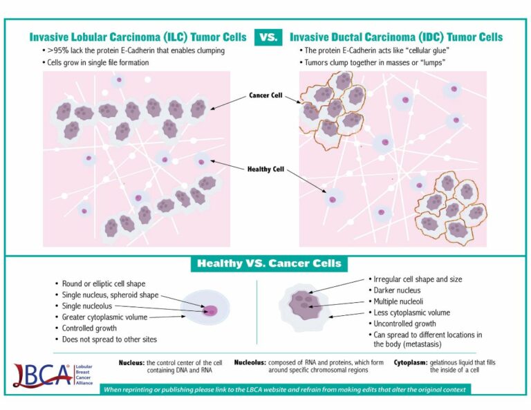 Infographic of differences between ILC vs. IDC tumors