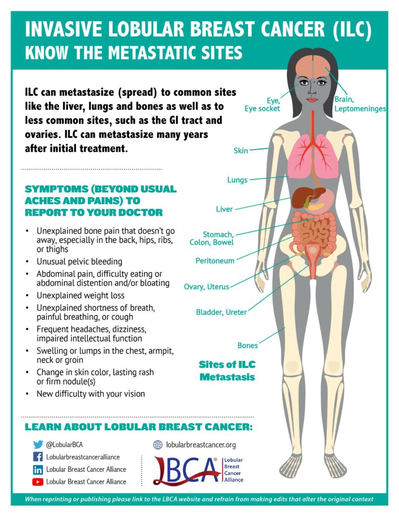 Infographic of where lobular breast cancer can metastacize