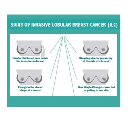 Lobular Breast Cancer Signs and Symptoms