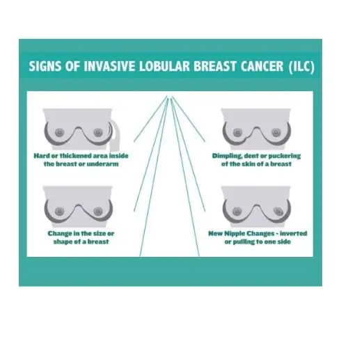 Lobular Breast Cancer Signs and Symptoms